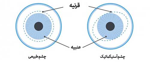 درمان آستیگماتیسم چشم