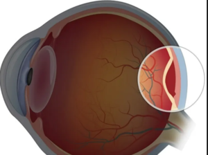 جداشدگی شبکیه چشم چیست و چه عواملی موجب آن می شود؟